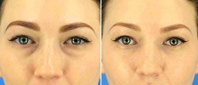 Eyelid Surgery Before & After Gallery - Patient 38566752 - Image 1