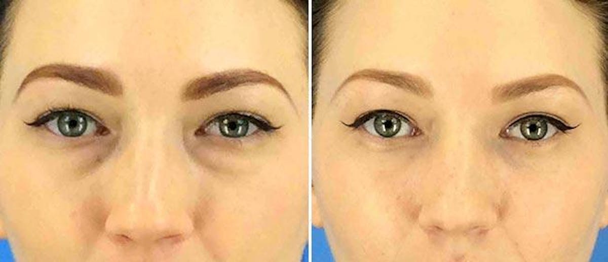 Eyelid Surgery Before & After Gallery - Patient 38566752 - Image 1