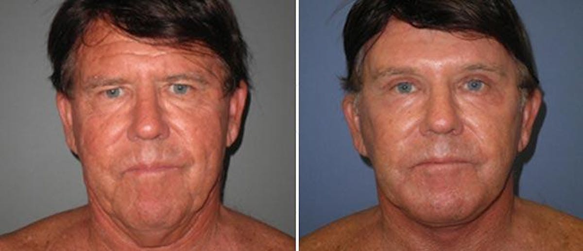 Facelift Before & After Gallery - Patient 38566753 - Image 1