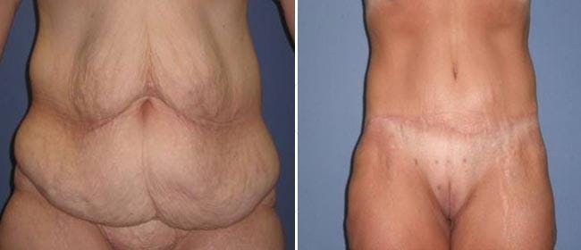 Abdominoplasty (Tummy Tuck) Before & After Gallery - Patient 38566754 - Image 1