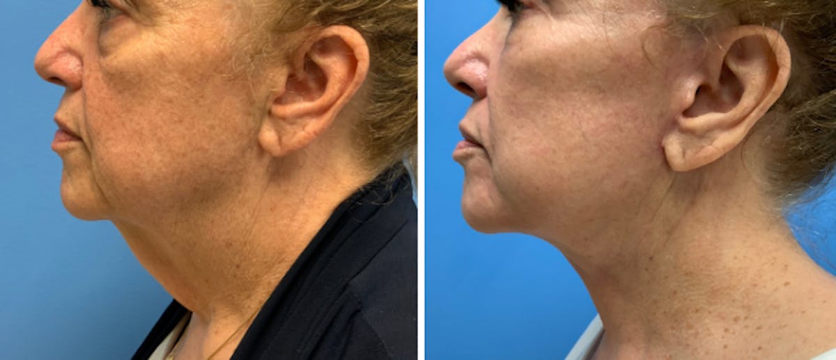 Neck Lift Before & After Gallery - Patient 38566744 - Image 3