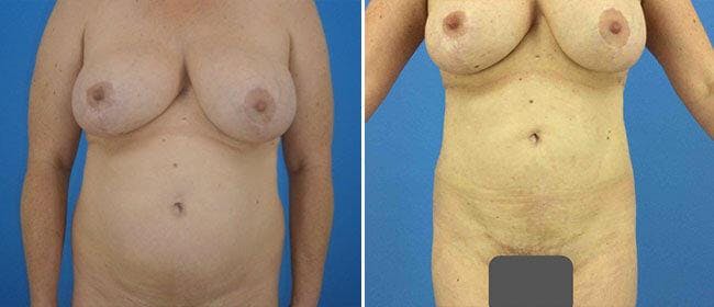 Liposuction Before & After Gallery - Patient 38566757 - Image 1
