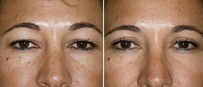 Eyelid Surgery Before & After Gallery - Patient 38566759 - Image 1
