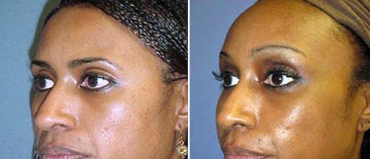 Facelift Before & After Gallery - Patient 38566758 - Image 1