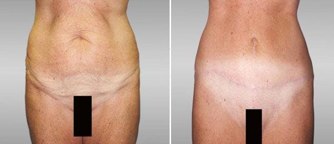 Abdominoplasty (Tummy Tuck) Before & After Gallery - Patient 38566760 - Image 1