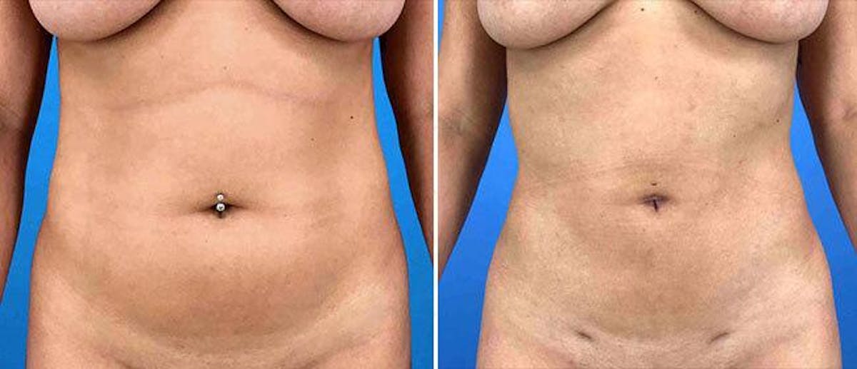 Liposuction Before & After Gallery - Patient 38566761 - Image 1