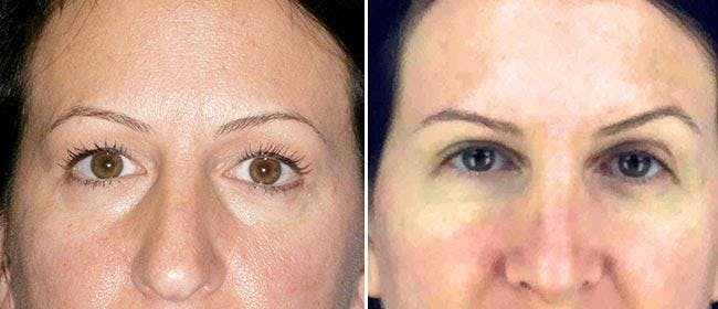 Eyelid Surgery Before & After Gallery - Patient 38566763 - Image 1