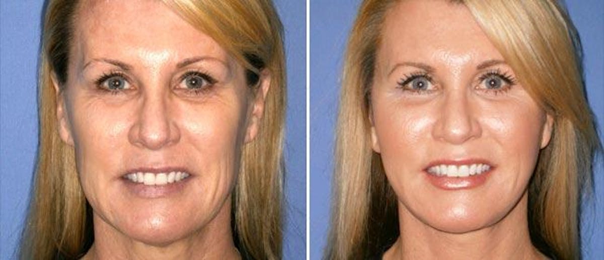Facelift Before & After Gallery - Patient 38566762 - Image 1