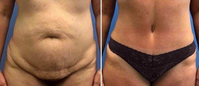 Abdominoplasty (Tummy Tuck) Before & After Gallery - Patient 38566766 - Image 1