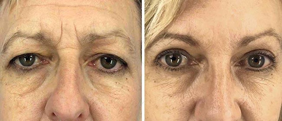 Eyelid Surgery Before & After Gallery - Patient 38566769 - Image 1