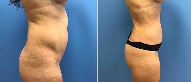Liposuction Before & After Gallery - Patient 38566768 - Image 1