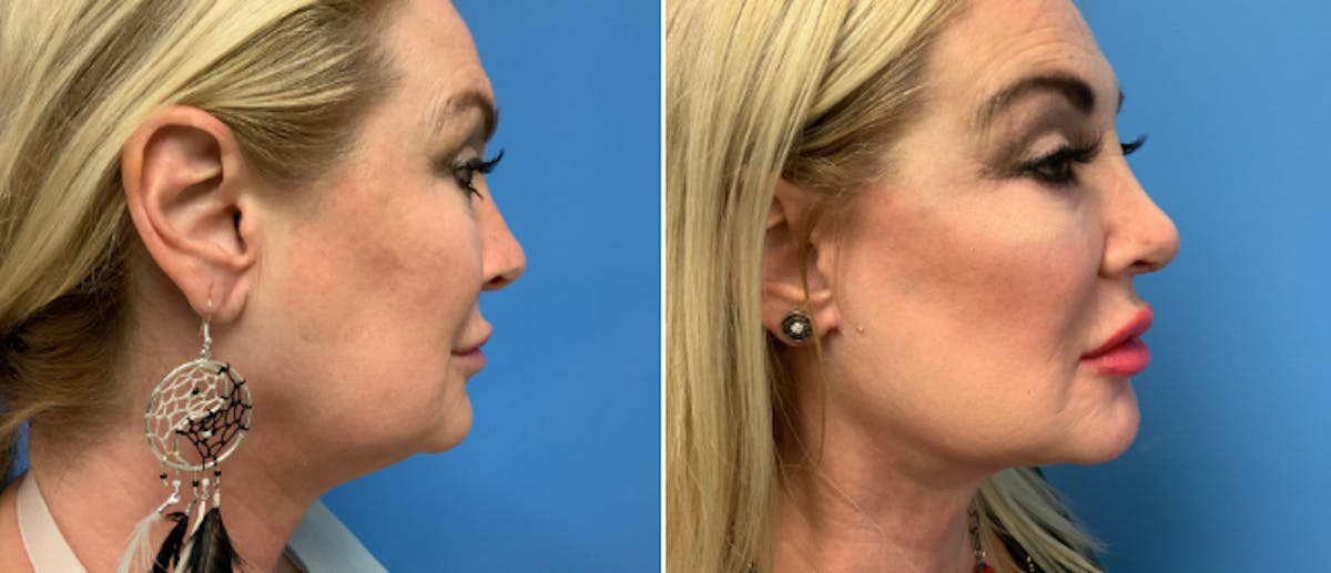 Neck Lift Before & After Gallery - Patient 38566765 - Image 2