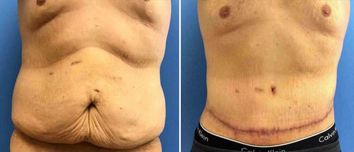 Tummy Tuck Before & After Gallery - Patient 38566771 - Image 1