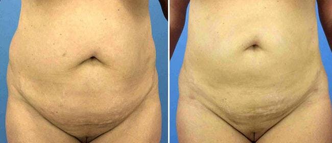 Liposuction Before & After Gallery - Patient 38566774 - Image 1