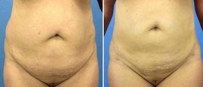 Liposuction Before & After Gallery - Patient 38566774 - Image 1