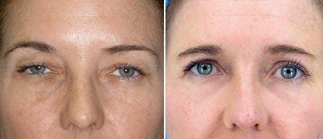 Eyelid Surgery Before & After Gallery - Patient 38566775 - Image 1
