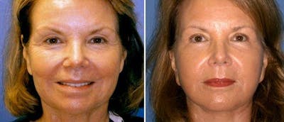 Facelift Before & After Gallery - Patient 38566773 - Image 1