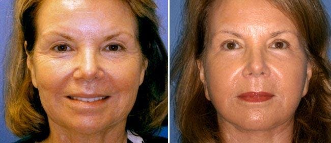 Facelift Before & After Gallery - Patient 38566773 - Image 1