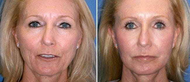 Facelift Before & After Gallery - Patient 38566776 - Image 1