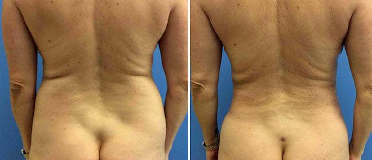 Liposuction Before & After Gallery - Patient 38566777 - Image 1