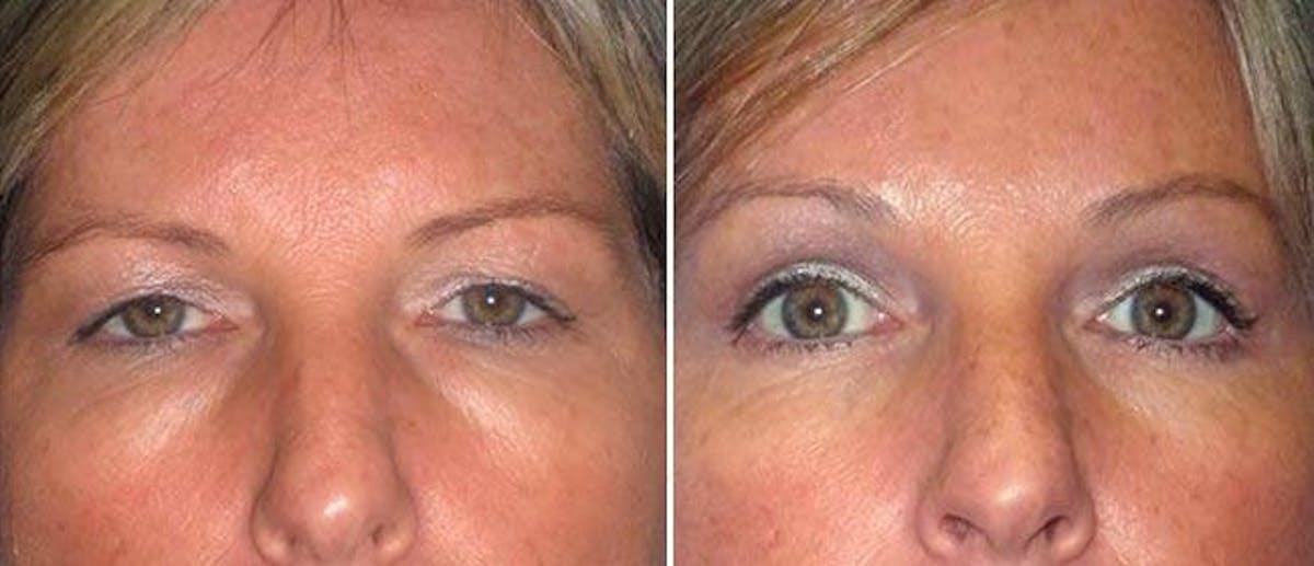 Eyelid Surgery Before & After Gallery - Patient 38566778 - Image 1