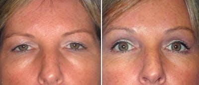 Eyelid Surgery Before & After Gallery - Patient 38566778 - Image 1
