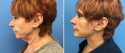 Facelift Before & After Gallery - Patient 38566780 - Image 1