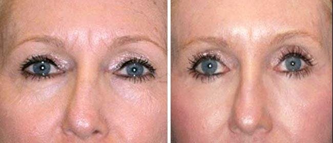 Eyelid Surgery Before & After Gallery - Patient 38566782 - Image 1