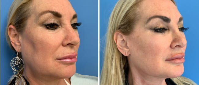 Neck Lift Before & After Gallery - Patient 38566765 - Image 4