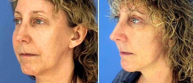 Facelift Before & After Gallery - Patient 38566784 - Image 1