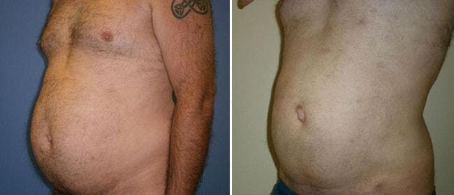 Liposuction Before & After Gallery - Patient 38566785 - Image 1