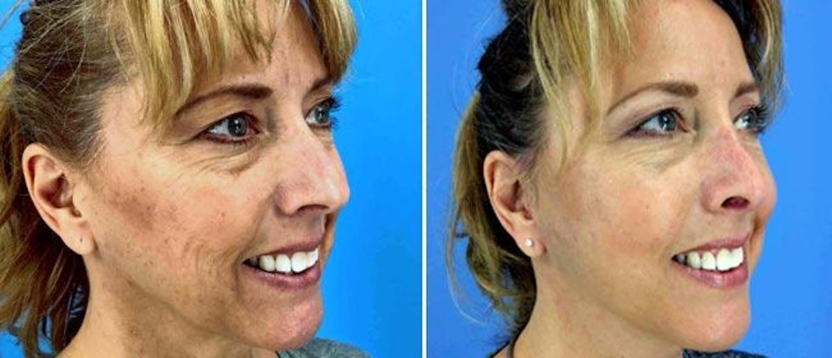 Facelift Before & After Gallery - Patient 38566787 - Image 1
