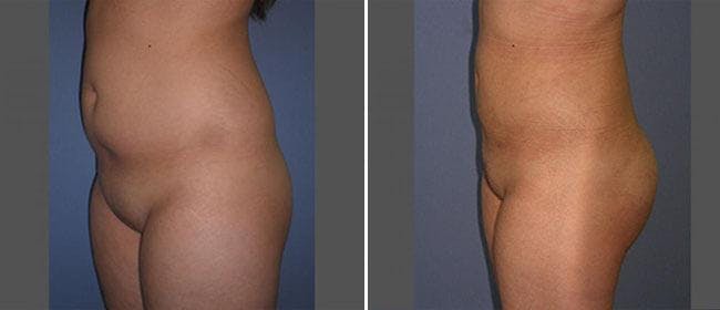 Liposuction Before & After Gallery - Patient 38566788 - Image 1