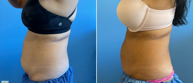 Coolsculpting Before & After Gallery - Patient 38566789 - Image 1