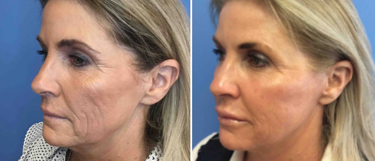 Neck Lift Before & After Gallery - Patient 38566790 - Image 1
