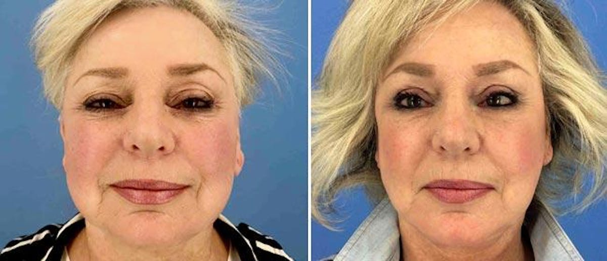 Facelift Before & After Gallery - Patient 38566791 - Image 1
