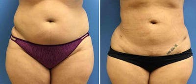Liposuction Before & After Gallery - Patient 38566792 - Image 1