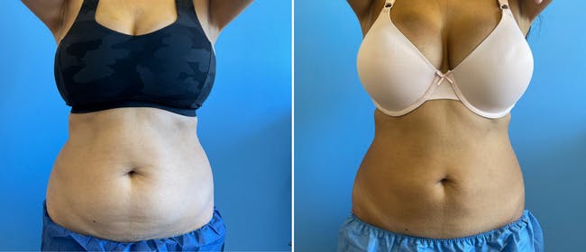 Coolsculpting Before & After Gallery - Patient 38566789 - Image 2