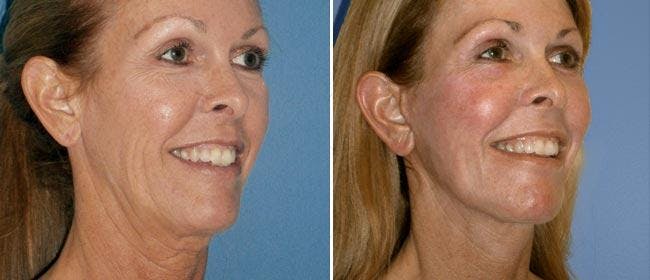 Facelift Before & After Gallery - Patient 38566794 - Image 1