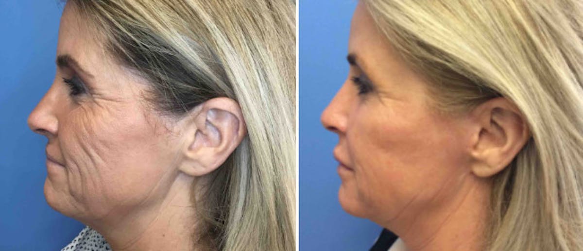 Neck Lift Before & After Gallery - Patient 38566790 - Image 2