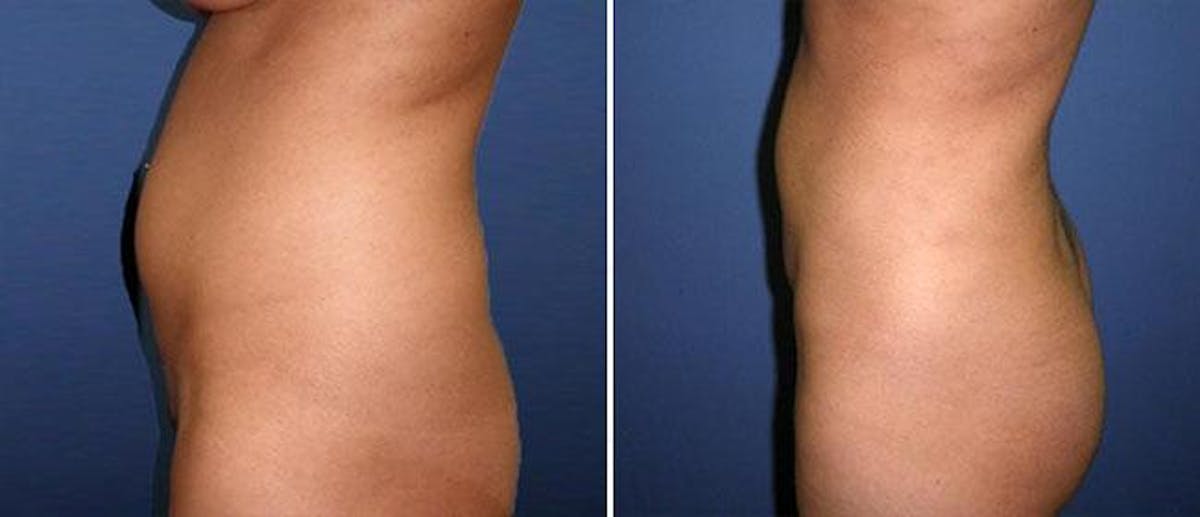 Liposuction Before & After Gallery - Patient 38566796 - Image 1