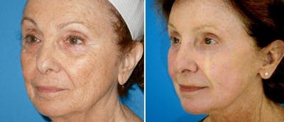 Facelift Before & After Gallery - Patient 38566798 - Image 1