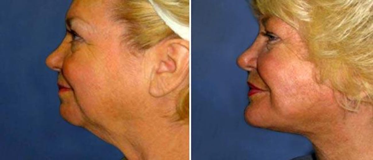 Neck Lift Before & After Gallery - Patient 38566797 - Image 1