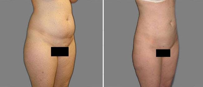 Liposuction Before & After Gallery - Patient 38566799 - Image 1