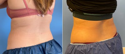Coolsculpting Before & After Gallery - Patient 38566800 - Image 1