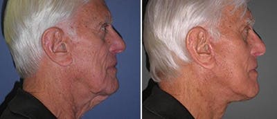 Neck Lift Before & After Gallery - Patient 38566801 - Image 1