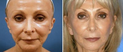 Facelift Before & After Gallery - Patient 38566803 - Image 1
