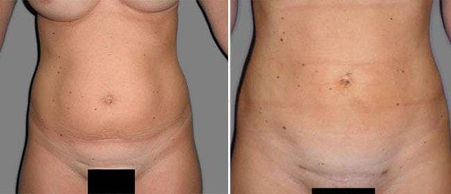 Liposuction Before & After Gallery - Patient 38566804 - Image 1