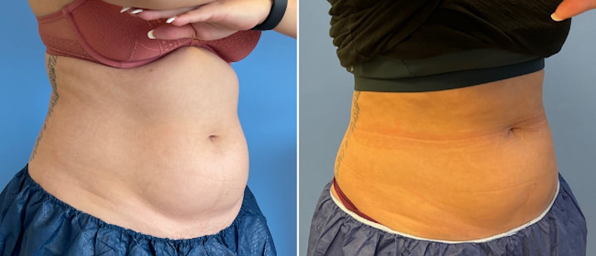 Coolsculpting Before & After Gallery - Patient 38566800 - Image 2