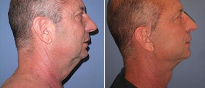 Neck Lift Before & After Gallery - Patient 38566806 - Image 1